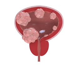 Cáncer de vejiga
