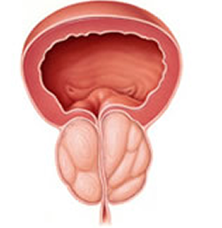 Hiperplasia Prostática